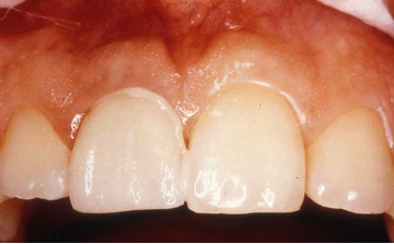 Photograph showing the veneer cemented in place.