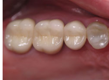Photograph of teeth after full crowns.