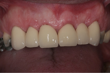 Photograph showing the front of a metal lined crowned tooth.