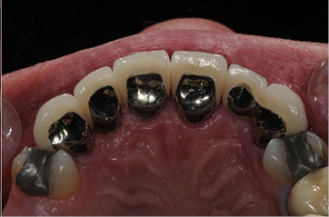 Photograph showing the back of a metal lined crowned tooth.