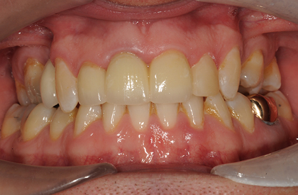 Photograph of tooth showing metal alloy crown within teeth.