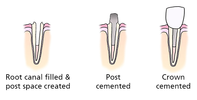 Three illustrations:
1. Root canal filled and post space created.
2. Post cemented
3. Crown cemented