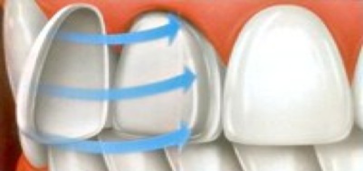 Illustration of veneer.