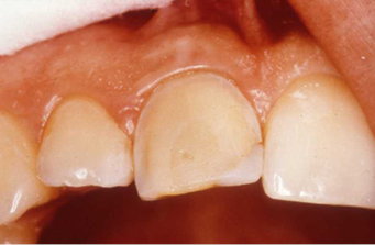 Photograph showing the tooth with the enamel layer removed. 