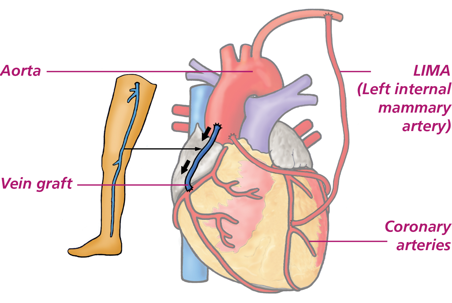 Illustration showing a coronary artery bypass graft