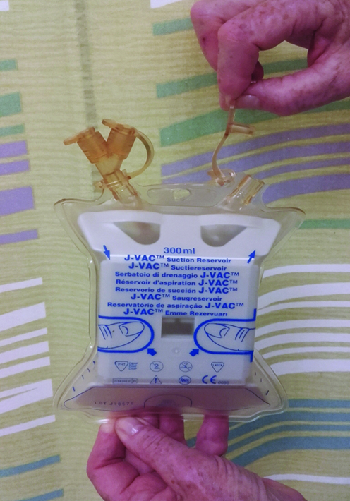 An image of relieving the negative pressure by opening the exit plug on the J-VAC reservoir