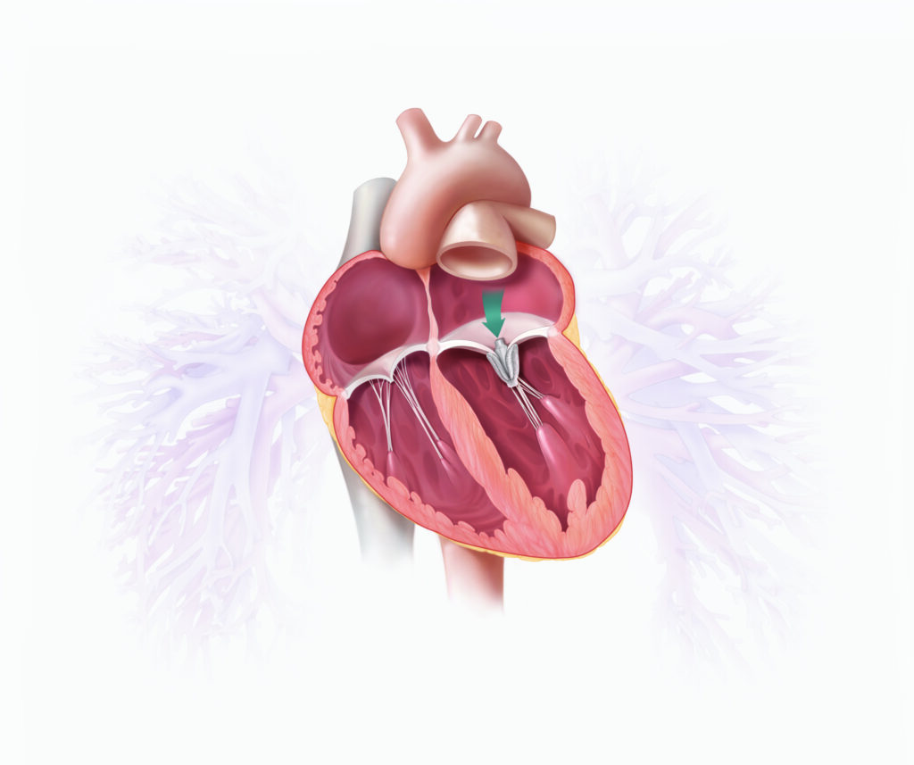 Illustration of a cross section of the heart with an arrow pointing to the inter-atrial septum
