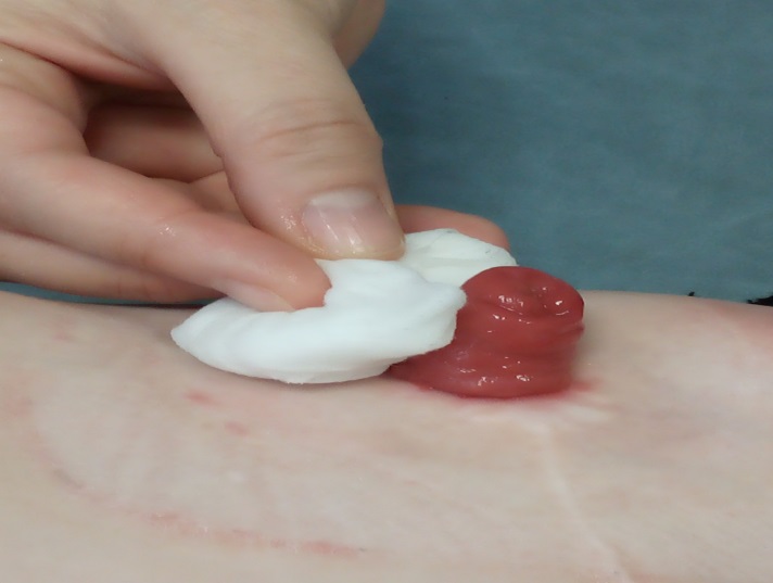 Photo showing how to clean the stoma