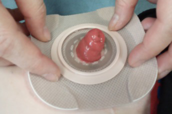Photo showing how to place the baseplate over the stoma and onto the abdomen
