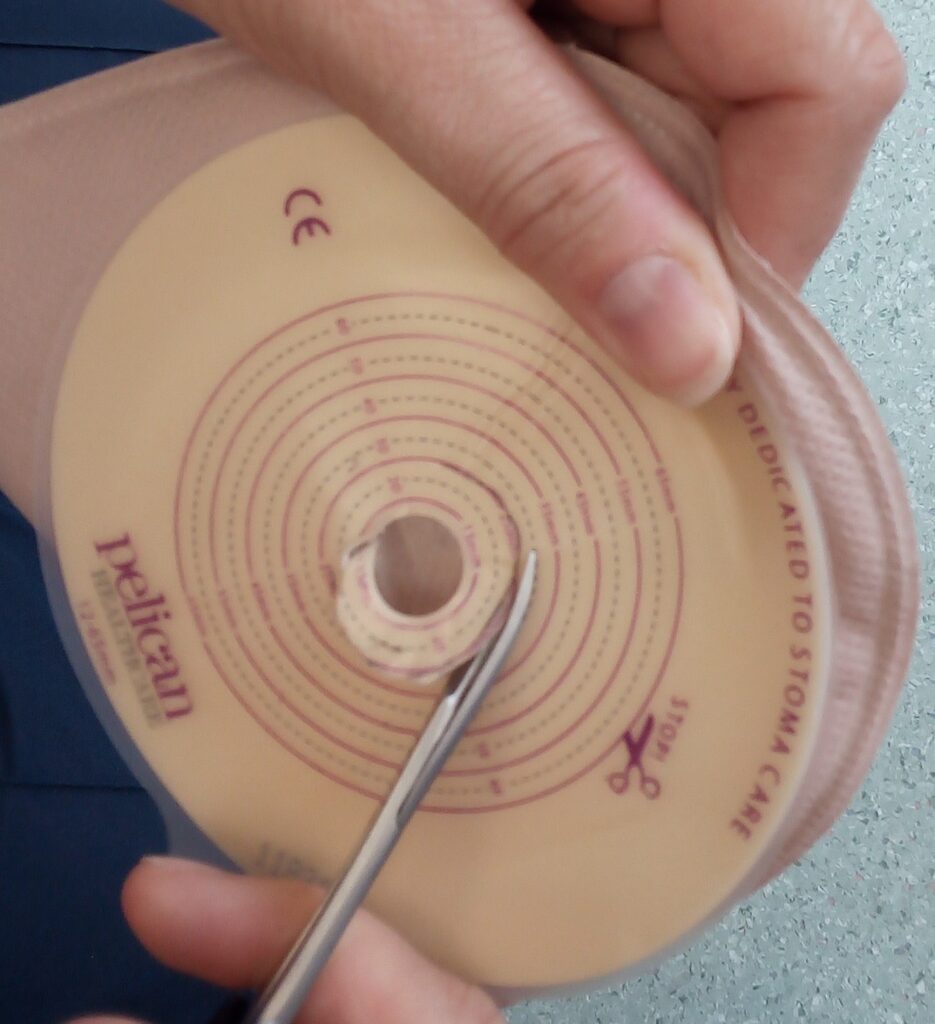 Photo showing the cutting of the hole for the stoma in the new baseplate