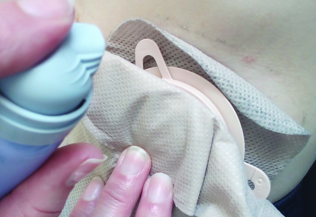 Photos showing how to use the remover spray to lift the flange off the skin