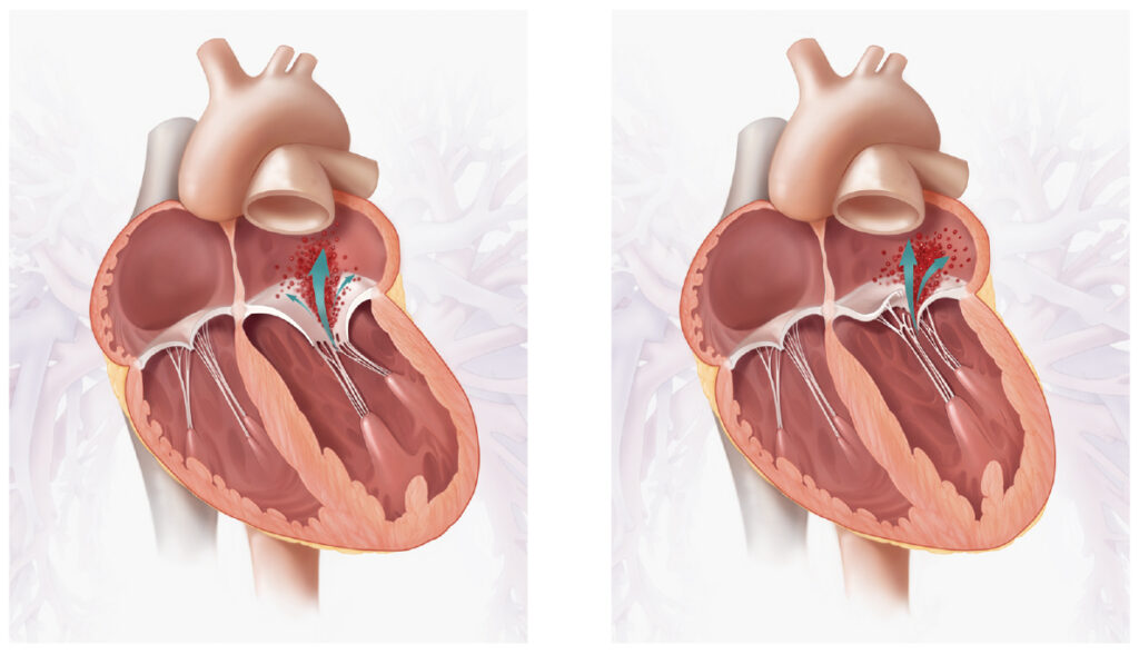 Two illustrations of a cross section of the heart showing blood leaking in the left atrium