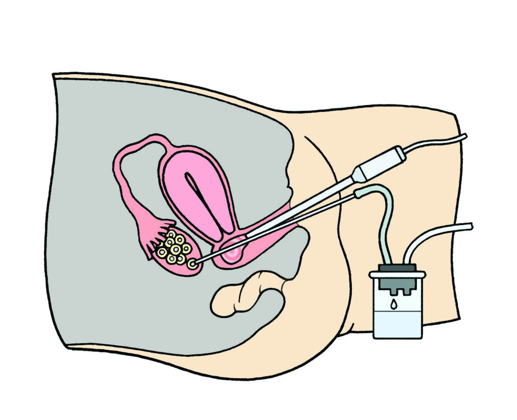 Illustration showing the procedure of egg collection from the ovaries via a vaginal approach.