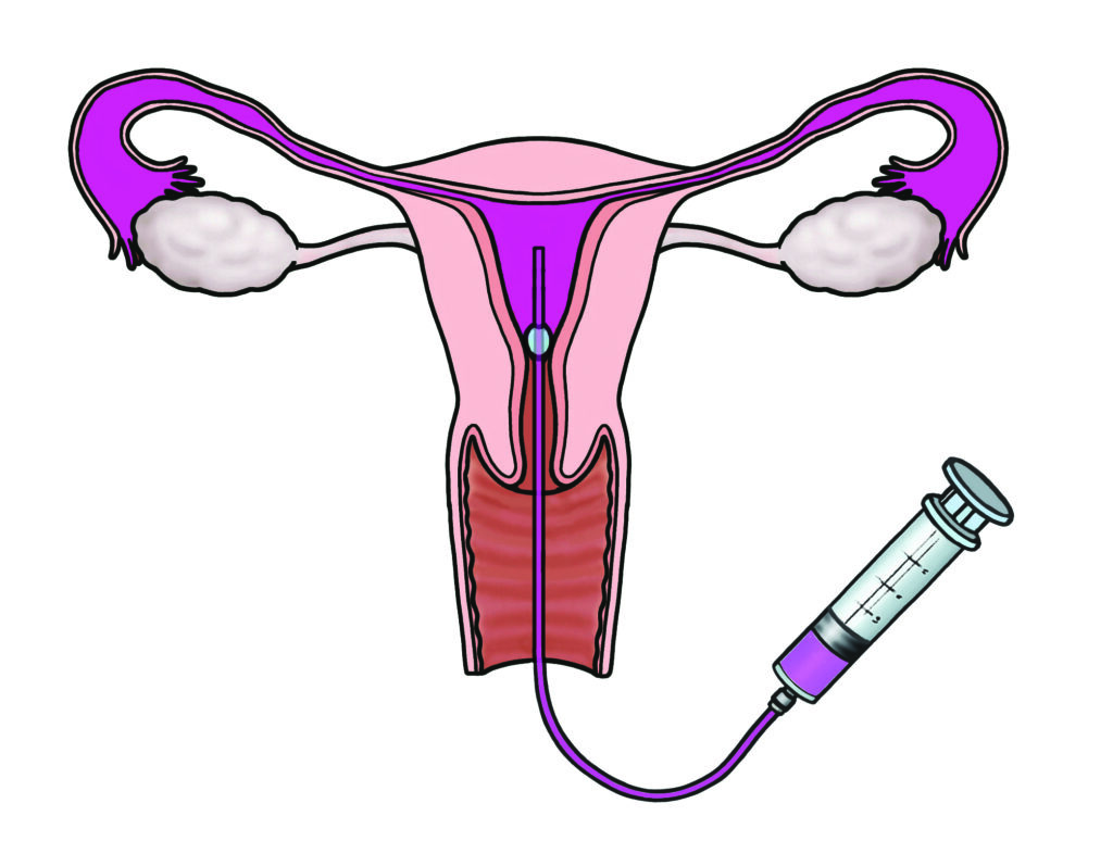 Illustration showing a soft plastic catheter inserted through the vagina and cervix to sit in the cavity of the womb with a small inflated balloon to plug the opening. A syringe is injecting some fluid through the catheter. 