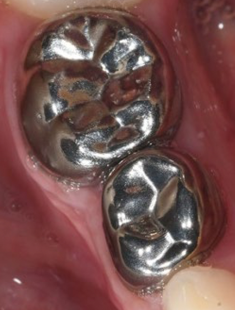 Photograph of silver crowns.