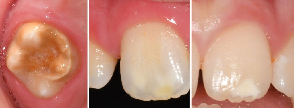 Images of a teeth with MIH.