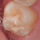 Image of a tooth with fissure sealant applied.