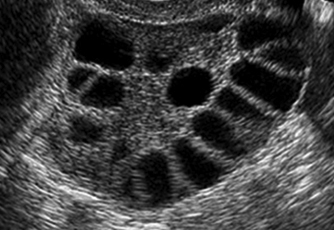 A scan picture of a polycystic ovary.