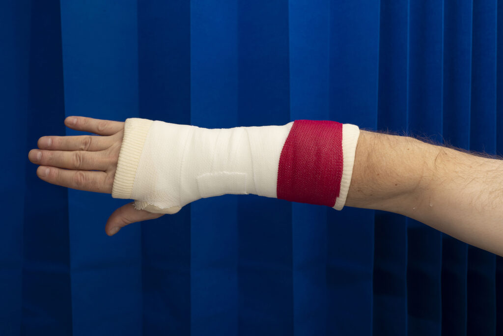 Example of a red band around a wrist cast