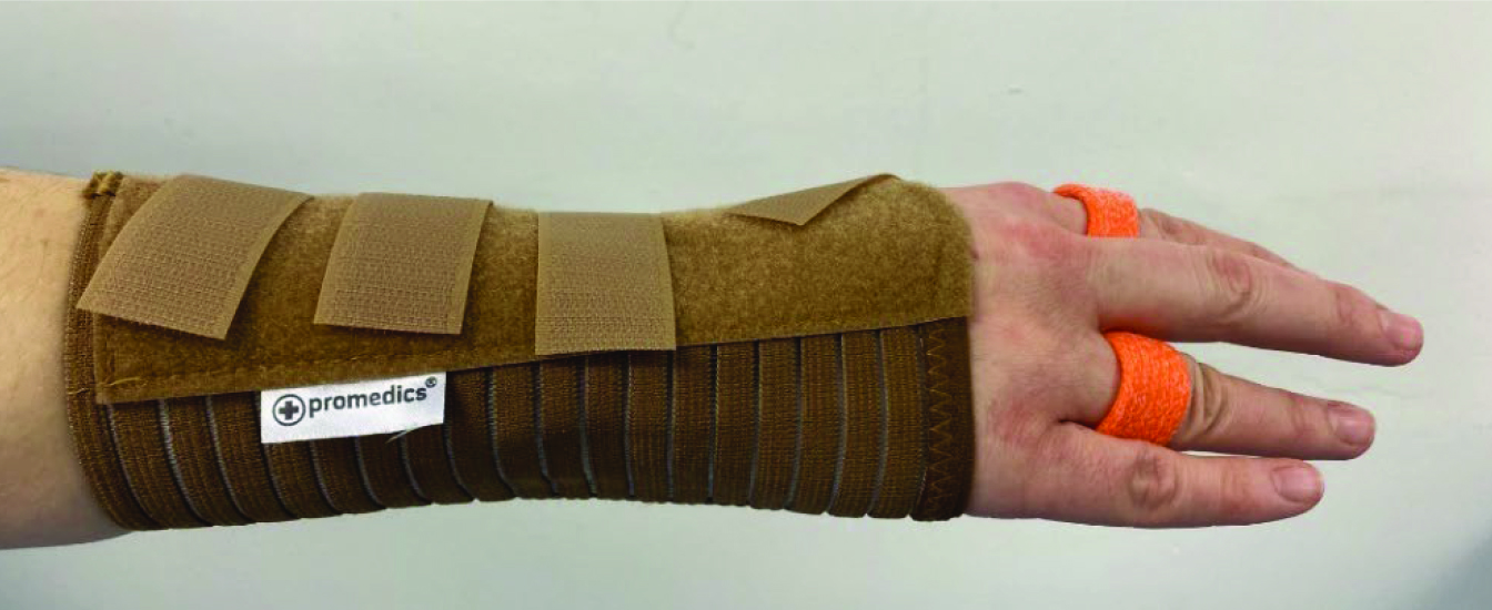 Photograph of a person wearing a wrist and finger splint.