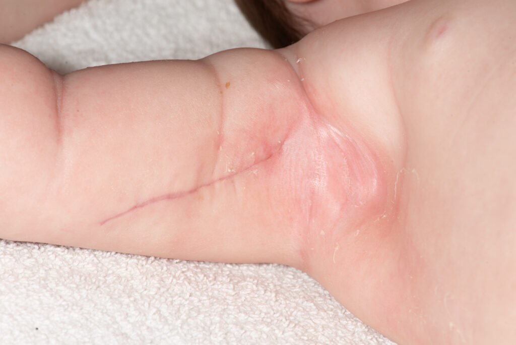 Photograph of healthy wounds, 4 weeks following primary nerve surgery. 