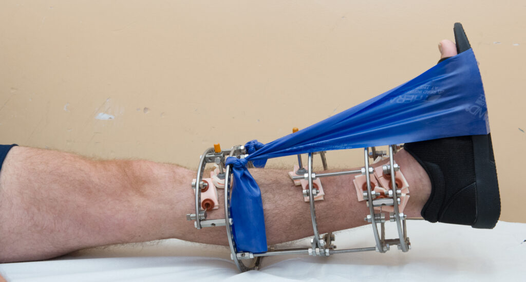 Photograph demonstrating Static Quads exercise.
Sit with affected leg out straight with your foot pointing upwards. Aim to get your knee as straight as possible. Hold for 10 seconds. 
Repeat 10 times.