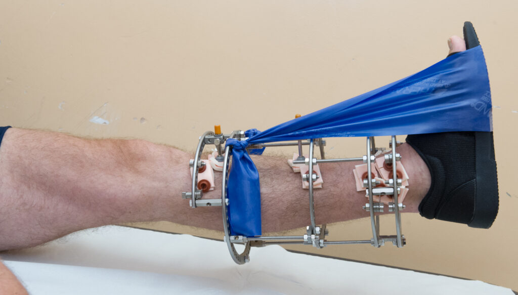 Photograph demonstrating Straight Leg Raise exercise.
Keeping knee straight, lift your foot and frame off the bed. Hold for 5 seconds. 
Repeat until the thigh muscle feels tired or until you are not able to hold your knee straight.