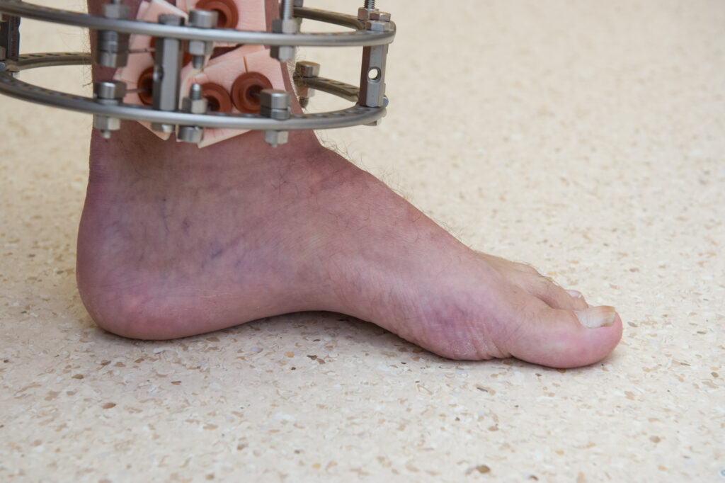 Photograph demonstrating Foot Posture exercise.
Sit with feet on the floor. Attempt to raise the arch of your foot with keeping your heel and toes on the floor.