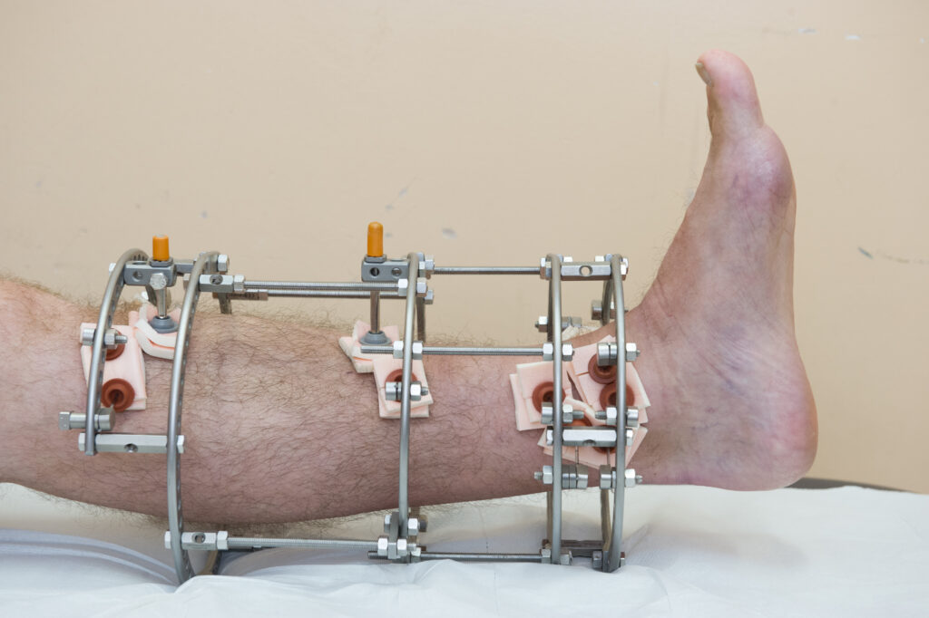 Photograph demonstrating Ankle Movement Upwards exercise.
Keeping knee straight, bring your foot up towards you.
Repeat 10 times.