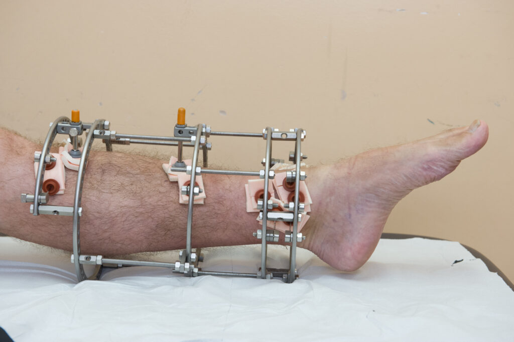 Photograph demonstrating Ankle Movement Downwards exercise.
Keeping the knee straight, point toes away from you. 
Repeat 10 times.