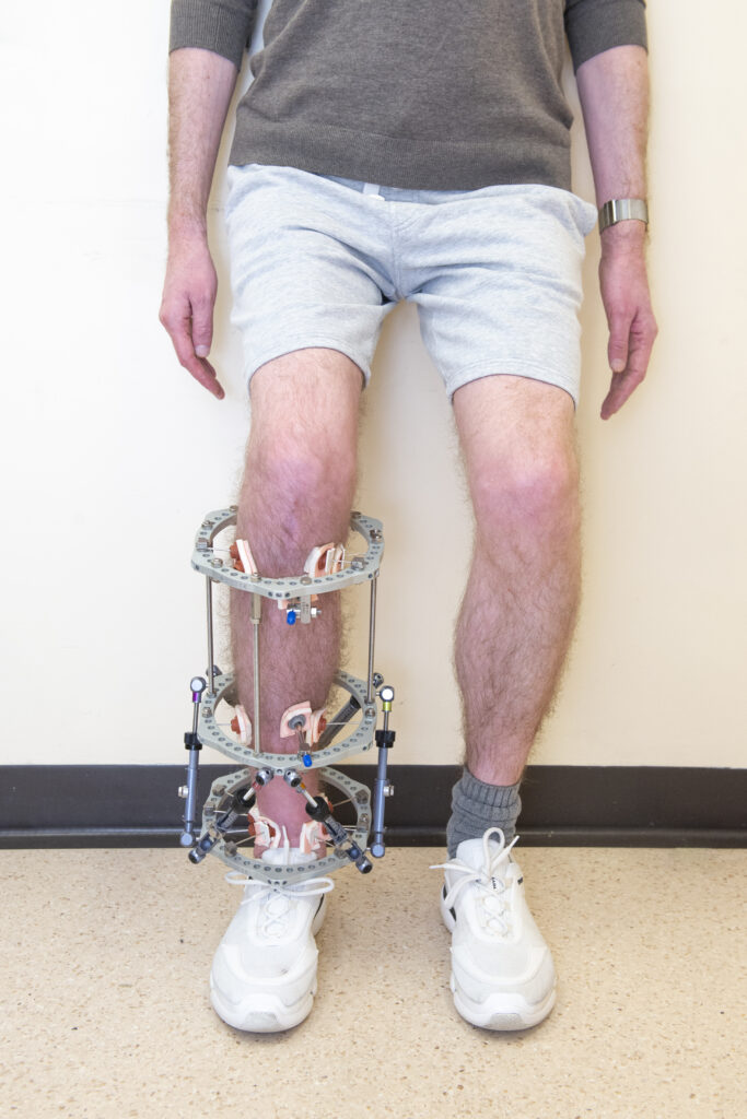 Photograph demonstrating Wall Slides exercise.
Stand with your back against the wall, feet slightly forwards and about shoulder width apart. Bend your knees and slid down the wall to about 45 degrees, try not to let your knees move inwards.
Hold for 10 seconds and return to stand position.
Repeat 5 times.