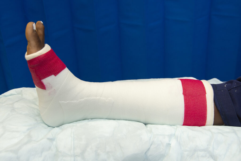 Example of a red band around a lower leg cast