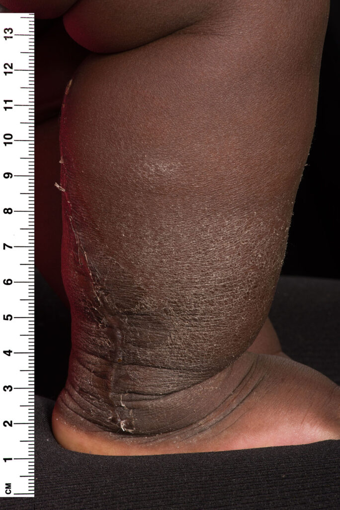 Photographs of healthy wounds, 4 weeks following primary nerve surgery. 