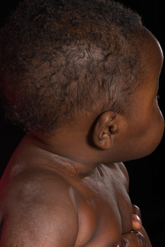 Photographs of healthy wounds, 4 weeks following primary nerve surgery. 