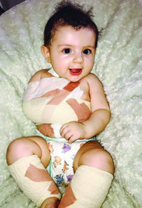 Picture of a child with bandages after nerve graft surgery to their right arm.