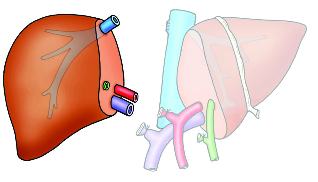 Diagram showing the piece of liver removed after a right hemihepatectomy.

