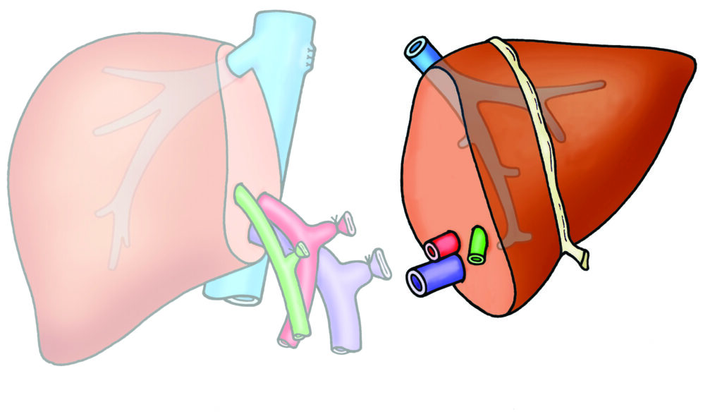Diagram showing the piece of liver removed in a left hemihepatectomy.