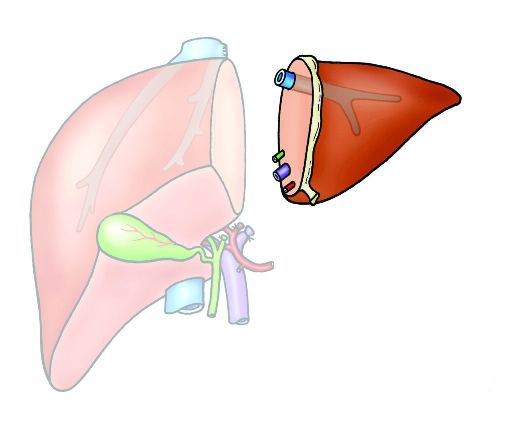 Diagram showing the piece of liver removed in a left lateral sectionectomy.