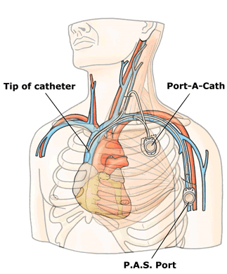 A diagram showing the location of the Catheter, Port-A-Cath and P.A.S. Ports in the body.