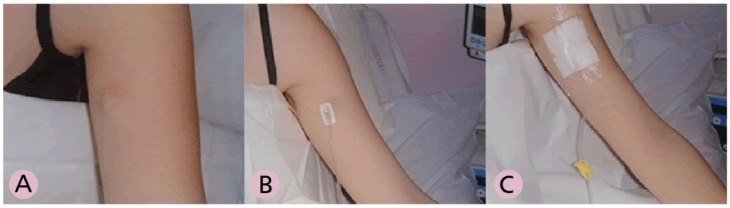 A set of three images labelled A, B and C.

A   showing the hub under the skin.

b   showing a needle inserted into the hub.

c   Showing a dressing over the needle to keep it clean and secure.