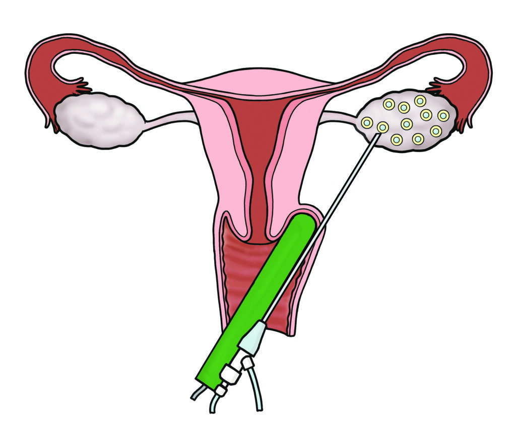 Illustration shows the vaginal ultrasound in position to allow the needle to reach the eggs in the ovary through the skin at the top of the vagina.