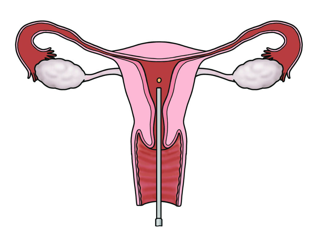 Image shows a catheter tube passing through the cervix to release an embryo in the heart of the womb cavity.