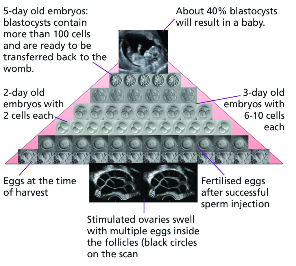 Image shows how a large number of eggs are needed to achieve a single pregnancy because lots of them will not make it through all the necessary stages-



Not all of the eggs harvested will fertilise; not all those fertilised will continue to divide and grow; not every embryo returned to the womb is strong enough to implant and produce a pregnancy.



An arrow points to a section with the following text: About 40% blastocysts will result in a baby.



An arrow points to a section with the following text: 5-day old embryos: blastocysts contain more than 100 cells and are ready to be transferred back to the womb.



An arrow points to a section with the following text: 3-day old embryos with 6-10 cells each.



An arrow points to a section with the following text: 2-day old embryos with 2 cells each.



An arrow points to a section with the following text: Eggs at the time of harvest.



An arrow points to a section with the following text: Stimulated ovaries swell with multiple eggs inside the follicles (black circles on the scan).



An arrow points to a section with the following text: Fertilised eggs after successful sperm injection.