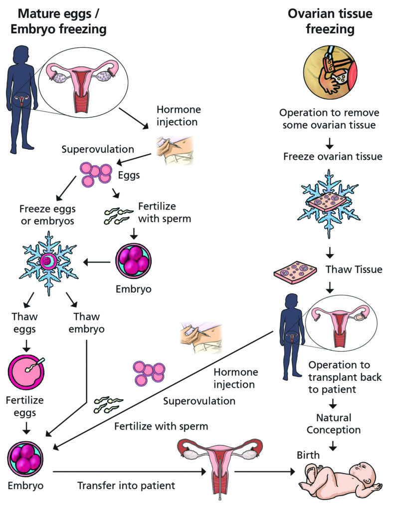 Image shows a slow chart summary of fertility preservation options including mature egg freezing, embryo freezing, ovarian tissue freezing and the pathways to a baby with each technique.