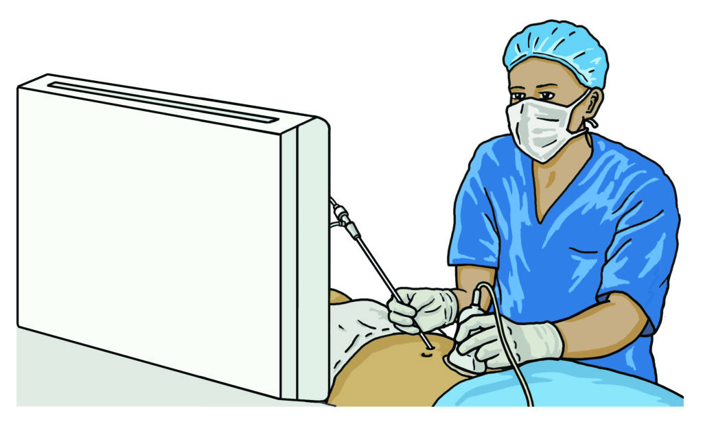 Illustration shows a doctor passing a needle through the belly under scan guidance to reach the ovaries from above.
