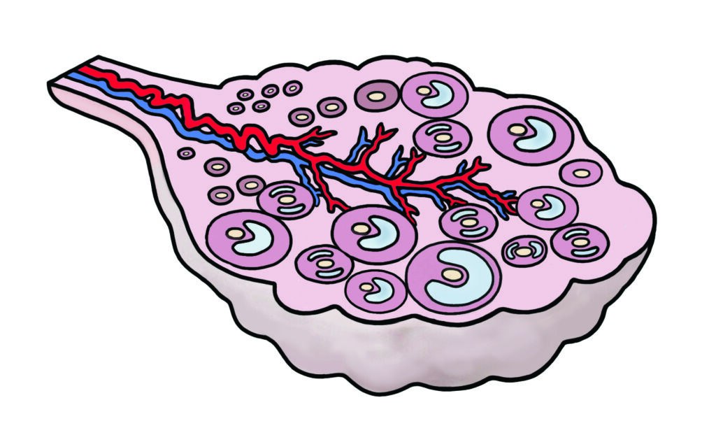 An illustration of a polycystic ovary. This shows more egg sacs than a normal ovary.