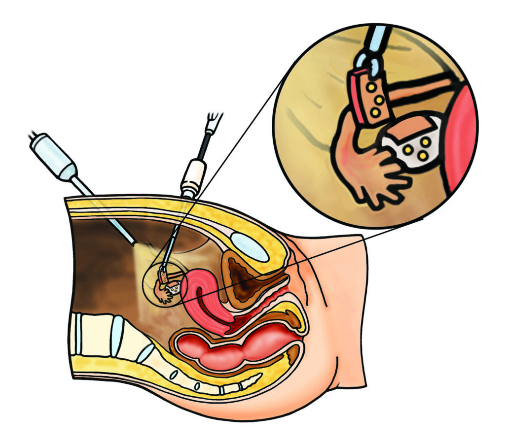 Image shows the position of keyhole surgical instruments in the belly reaching towards the ovary to take a piece away for freezing.
