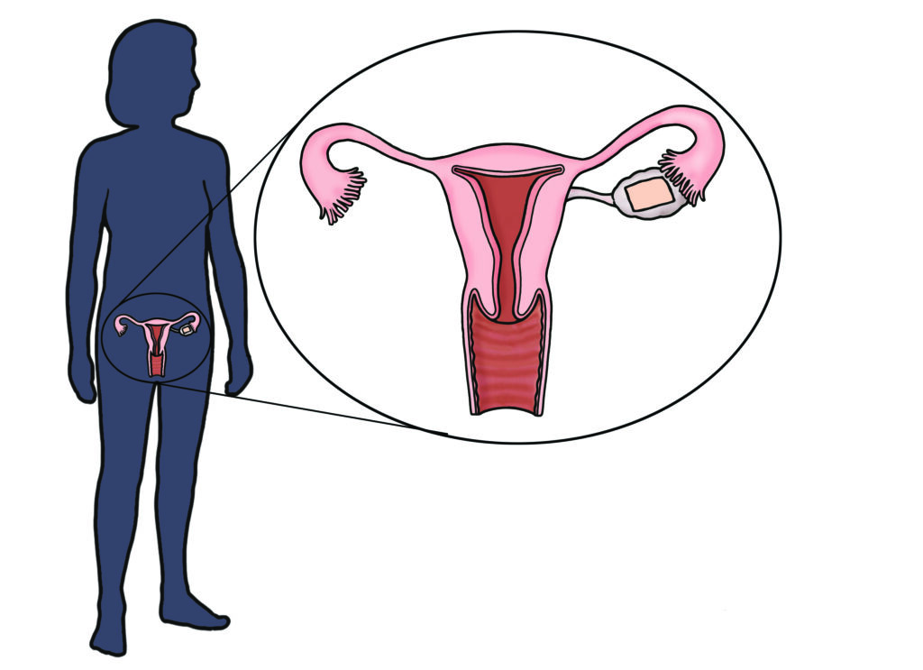 Image shows the figure of a woman with an expanded view of the womb and ovary with a patch on it to represent a transplanted piece of frozen thawed ovary.