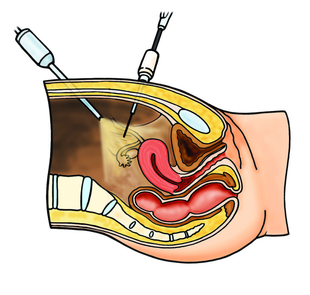 A cut-away drawing of the belly with the keyhole instruments in position.