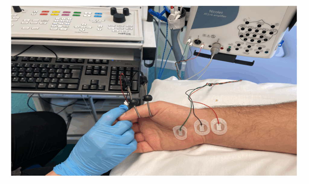 Photograph of a persons hand connected to a EMG test